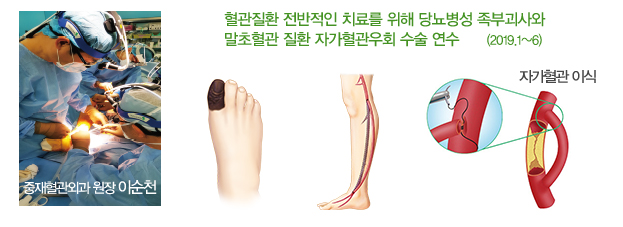 혈관질환 전반적인 치료를 위해 당뇨병성 족부괴사와 말초혈관 질환 자가혈관우회 수술 연수