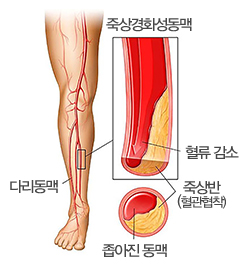 당뇨발 이미지2