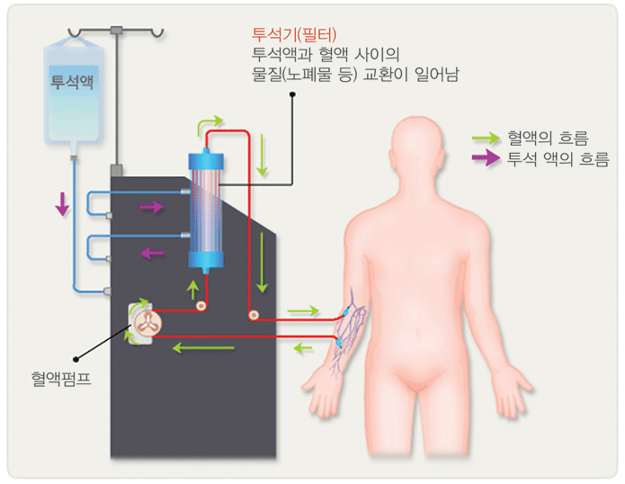 투석기 투석액과 혈액 사이의 물질(노폐물 등 )교환이 일어남